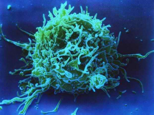 Φονικά κύτταρα εργαστηρίου εναντίον καρκίνου!