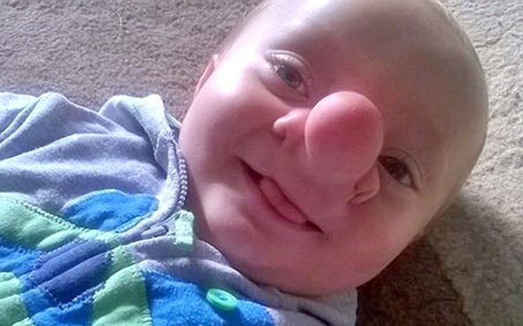 Το μωρό που μεγαλώνει με τον εγκέφαλο να αναπτύσσεται στη μύτη του [φωτό]