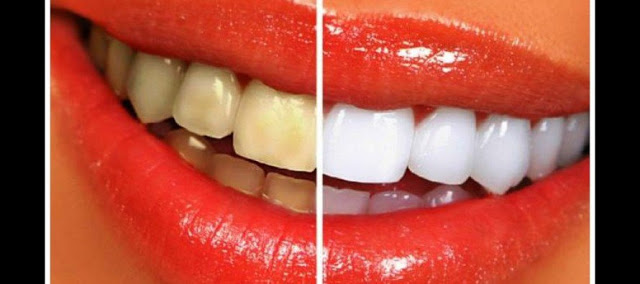 6 Τρόποι να λευκάνεις τα δόντια σου στο σπίτι! [φωτό]