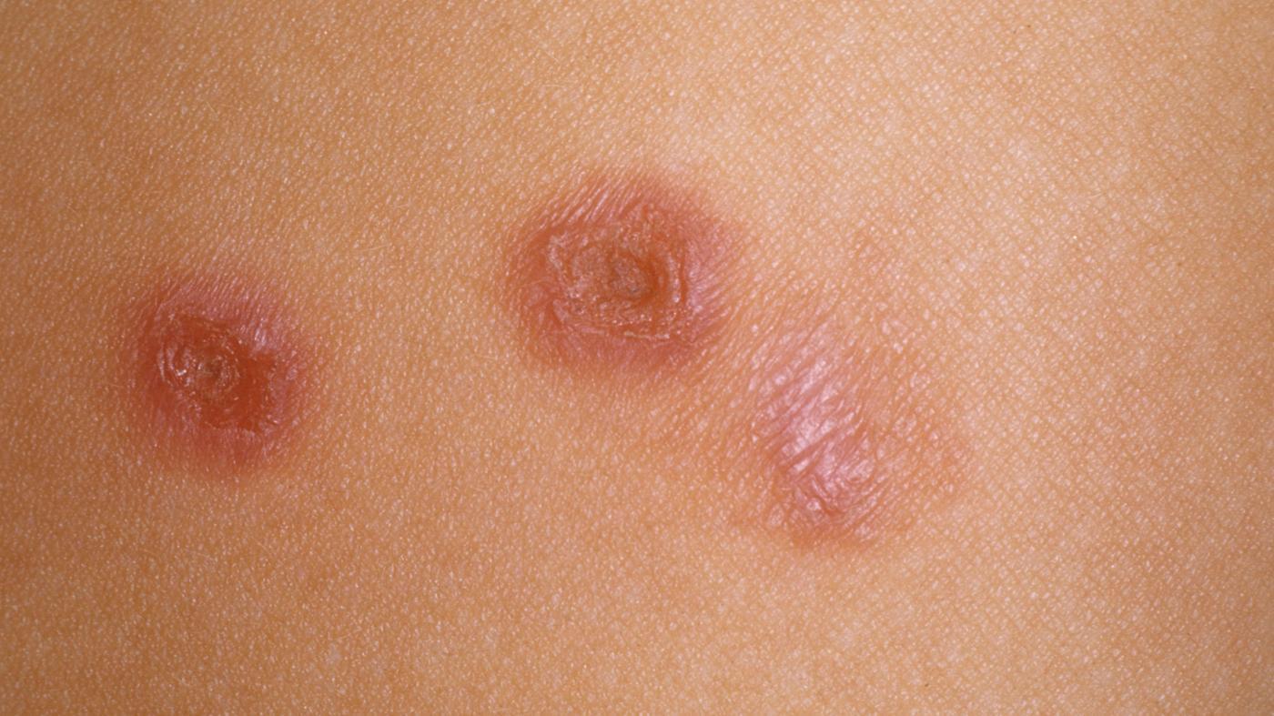 σταφυλόκοκκος