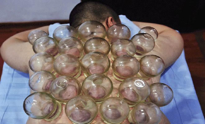 Τραγικό: Του έβαζαν βεντούζες για ένα μήνα και… δείτε τι έπαθε! (φωτό)