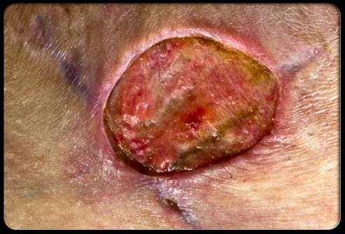 203staph-infection-s10-photo-of-methicillin-resistant-staphylococcus-aureus-infection