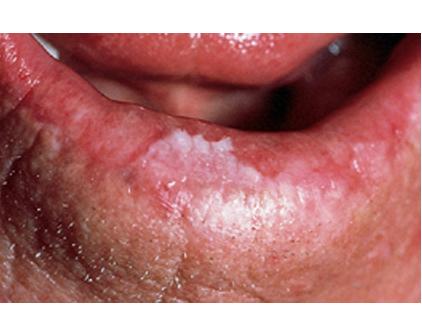 λευκές κηλίδες στα χείλη