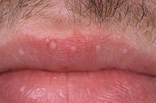 λευκές κηλίδες στα χείλη