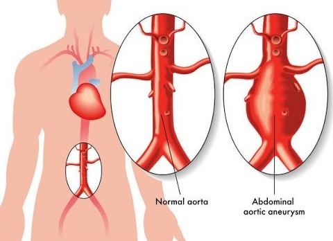 Aneurysm Repair