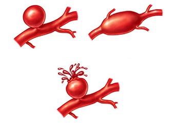 Cerebral Aneurusms 2col