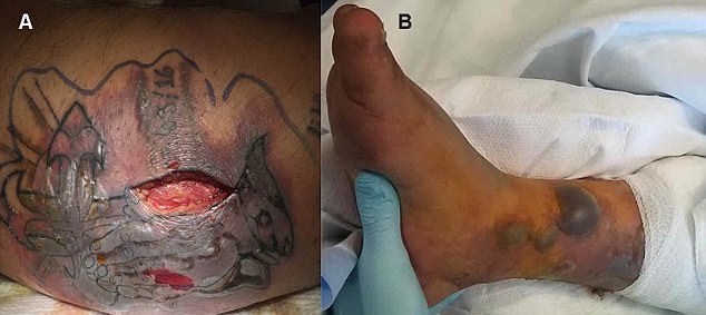 Νεκρός 31χρονος από μόλυνση στο φρέσκο του τατουάζ – Δείτε γιατί (φωτό)