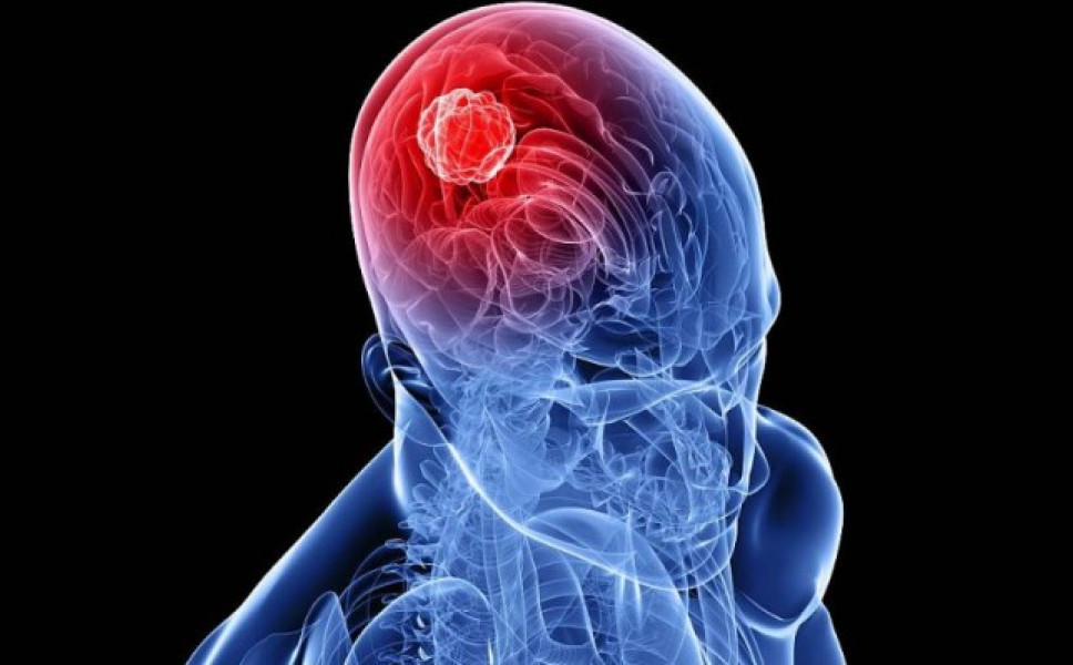 Δείτε ποια είναι τα ένοχα συμπτώματα του όγκου στο κεφάλι
