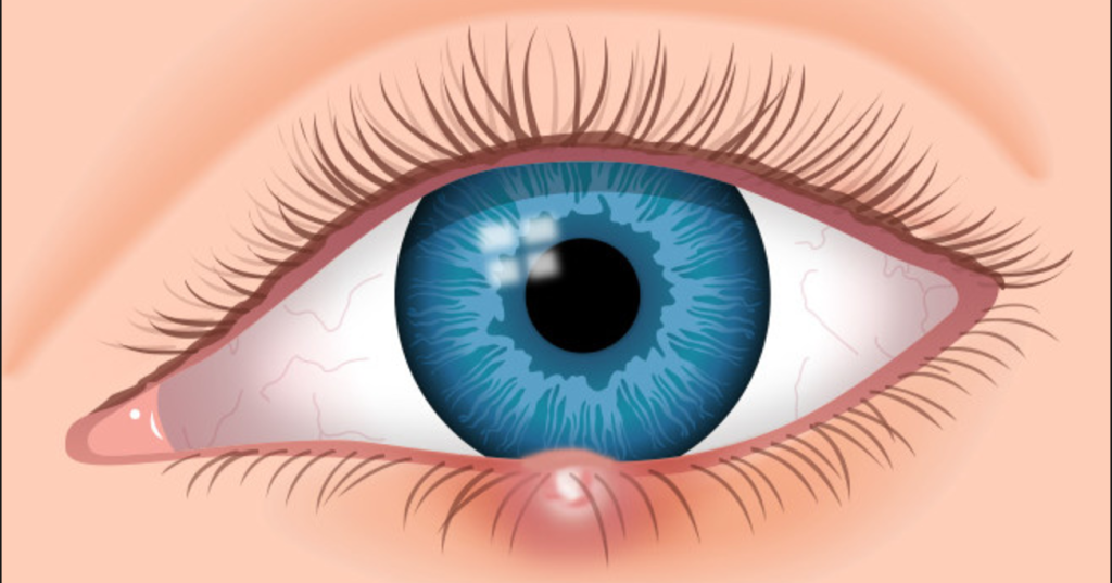 Κριθαράκι στο μάτι: Θεραπείες και πρόληψη