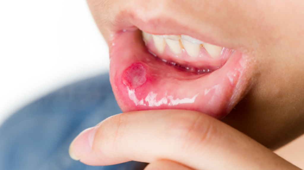 Καρκίνος του στόματος -Παράγοντες και συμπτώματα