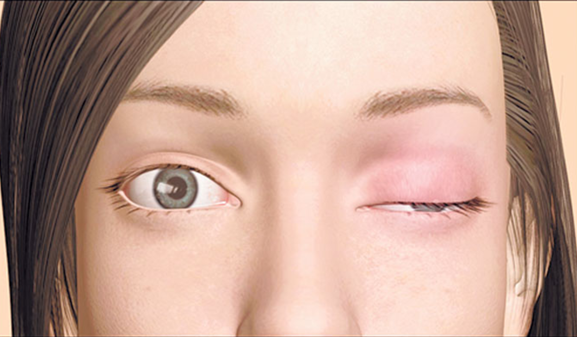 Βίντεο: Τι είναι η μυασθένεια Gravis και πώς αντιμετωπίζεται;