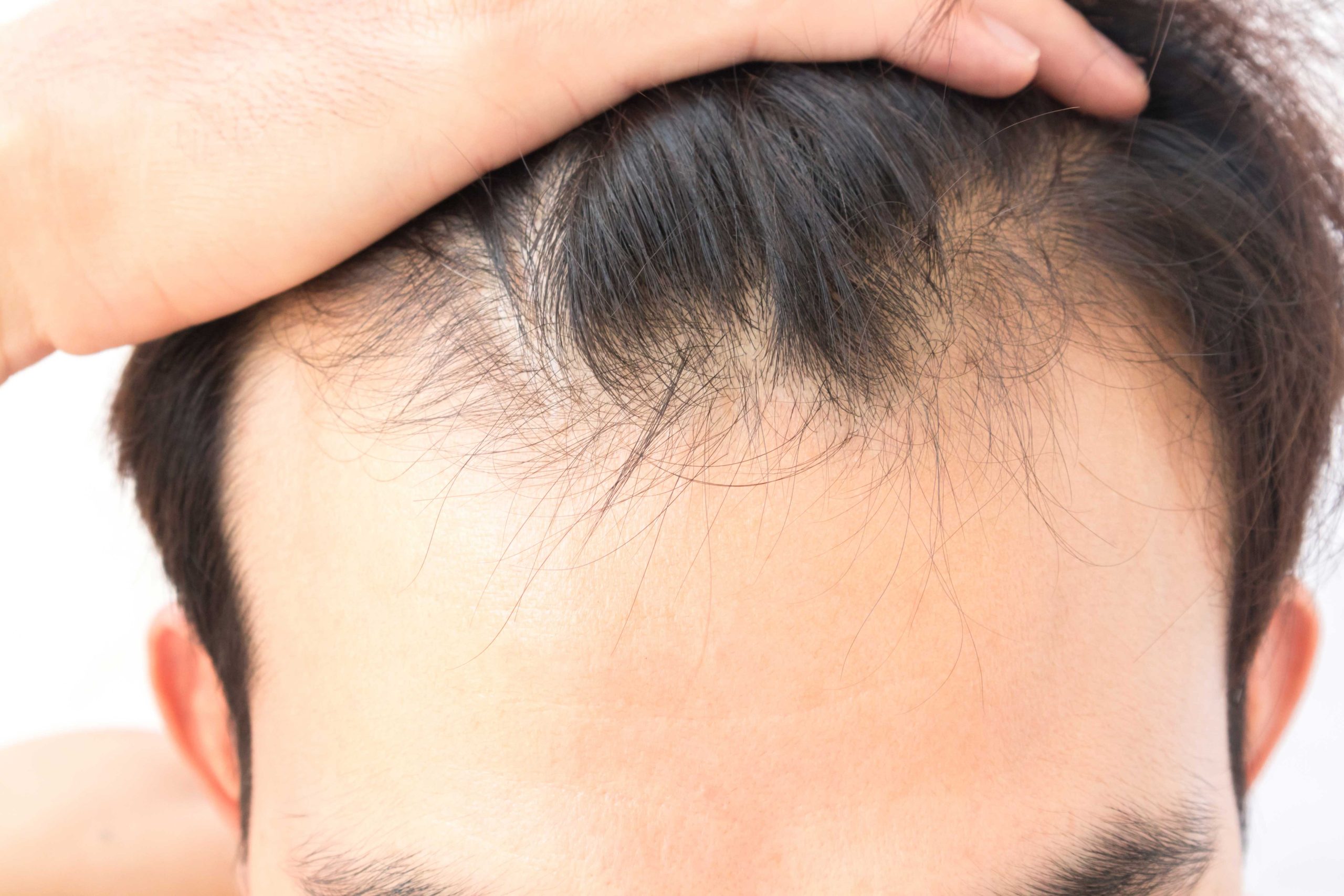Πως να αποφύγετε την αραίωση μαλλιών – Όλα όσα πρέπει να προσέξετε