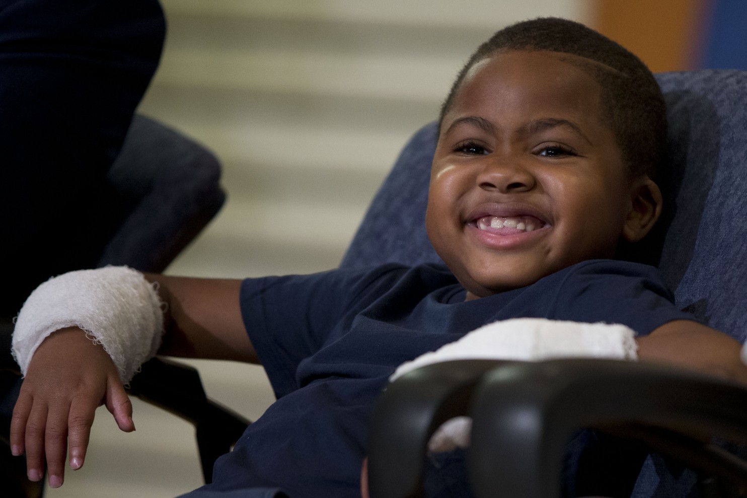 Ουάσινγκτον: Επιτυχημένη η πρώτη διπλή μεταμόσχευση χεριών στον κόσμο σε παιδί