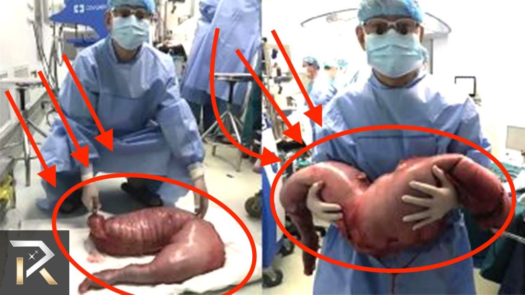 Βίντεο: «Άφωνοι» οι χειρουργοί απ’ αυτά που βρήκαν μέσα σ’ αυτούς τους ανθρώπους – Δεν θα τα πιστεύετε!