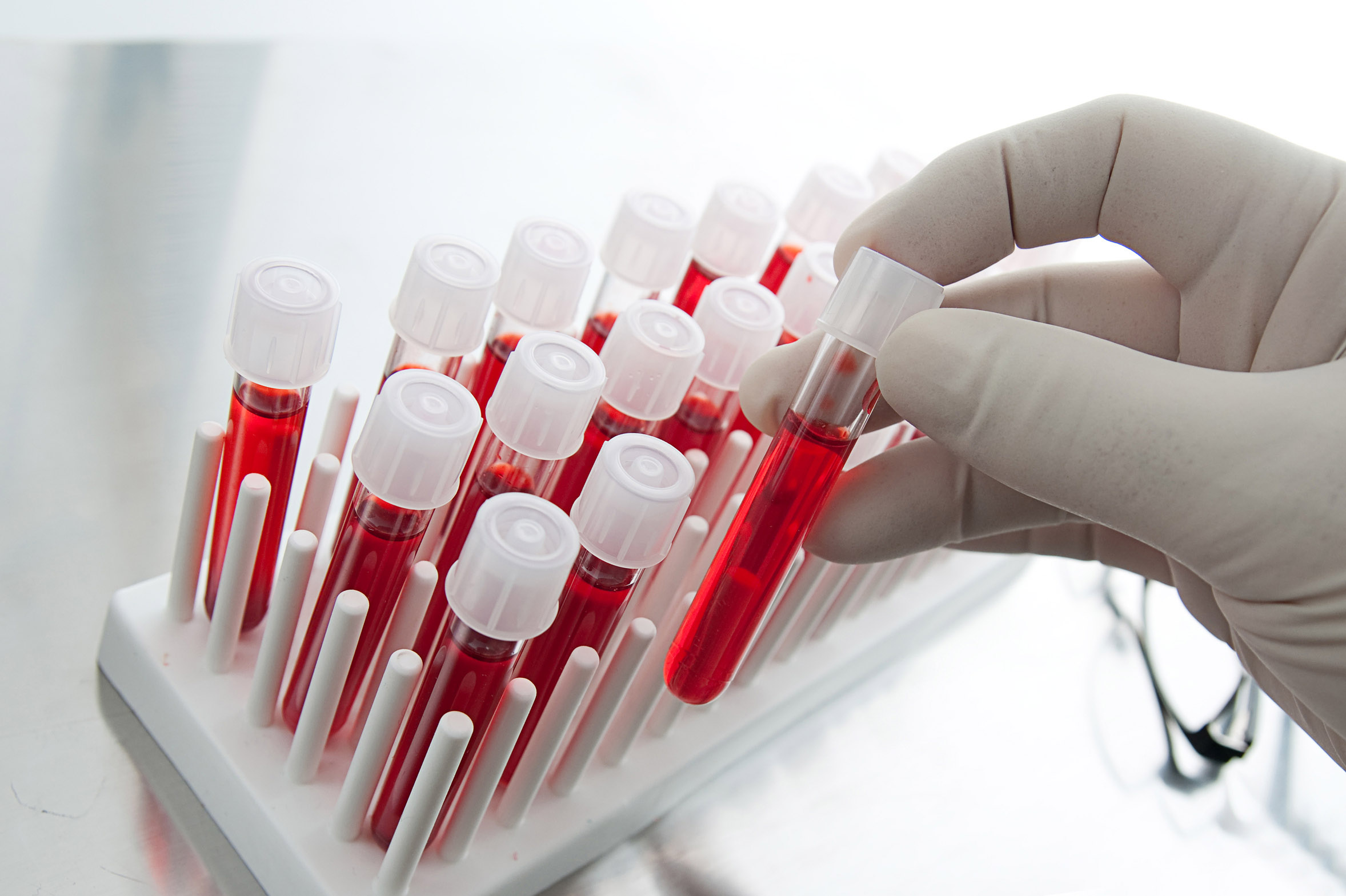 Μεγάλες ελπίδες από νέο τεστ αίματος που εντοπίζει τον καρκίνο πολύ αποτελεσματικά
