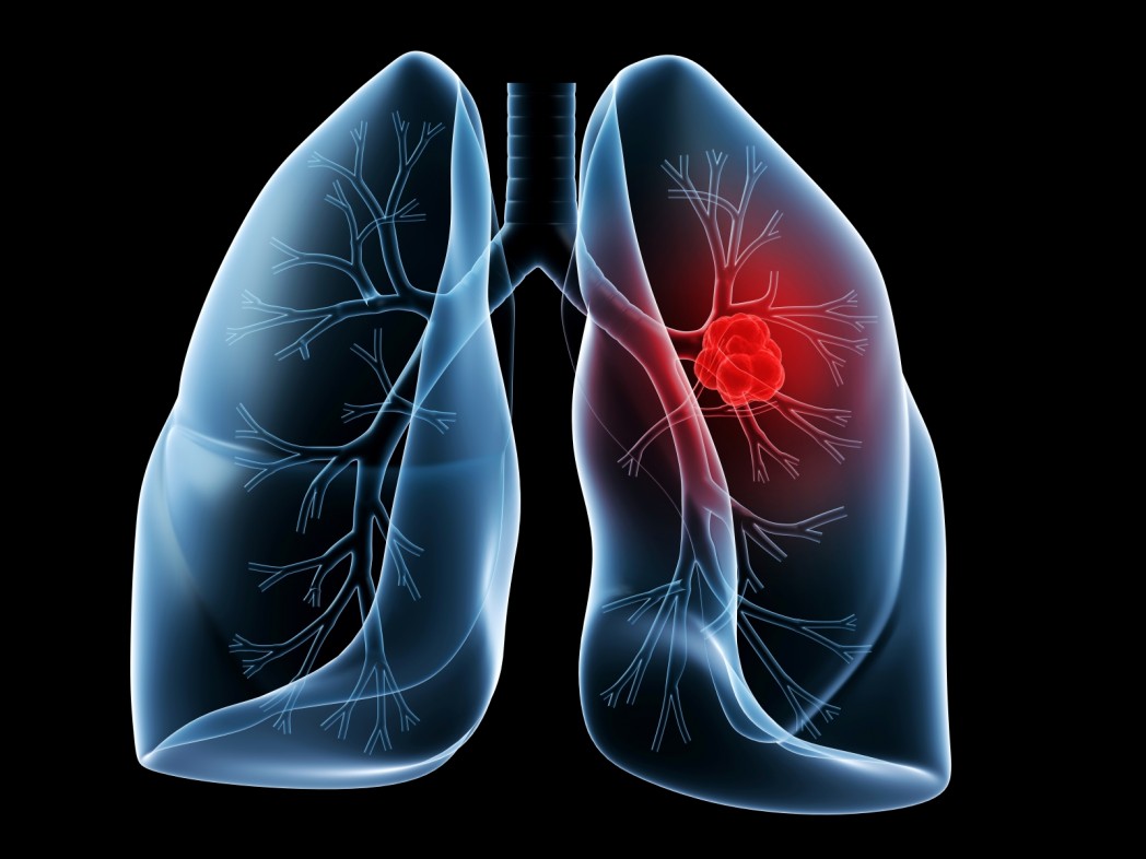 Η φυτική ουσία που «εξολοθρεύει» το 90% των κυττάρων του καρκίνου του πνεύμονα!