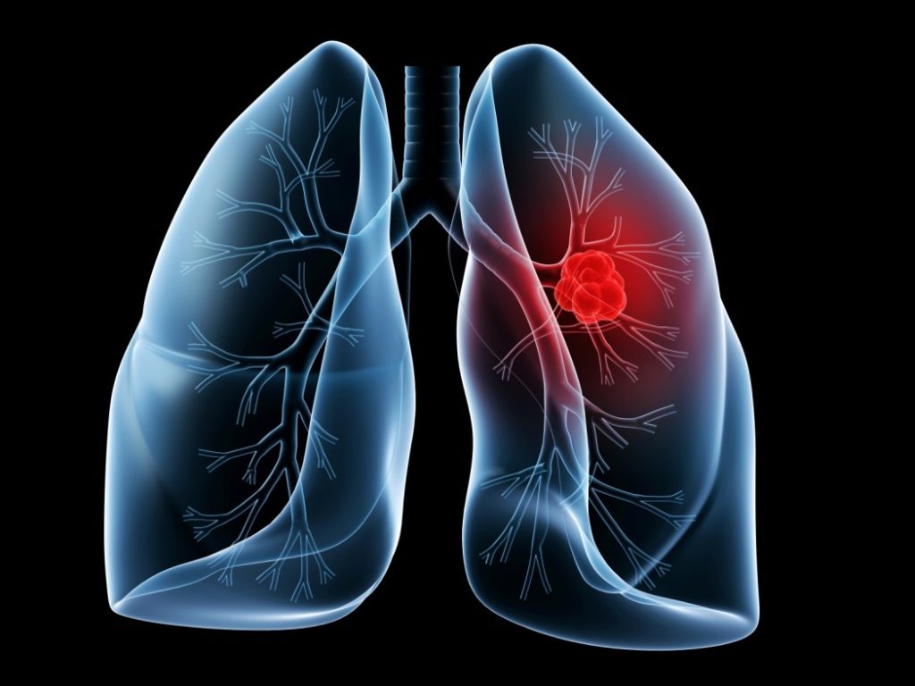 Καρκίνος του πνεύμονα: Πως συμβαίνει σε όσους δεν καπνίζουν