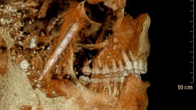 Τι ΔΕΝ τρώγανε οι Αρχαίοι Ρωμαίοι και δεν χρειάζονταν οδοντίατρο