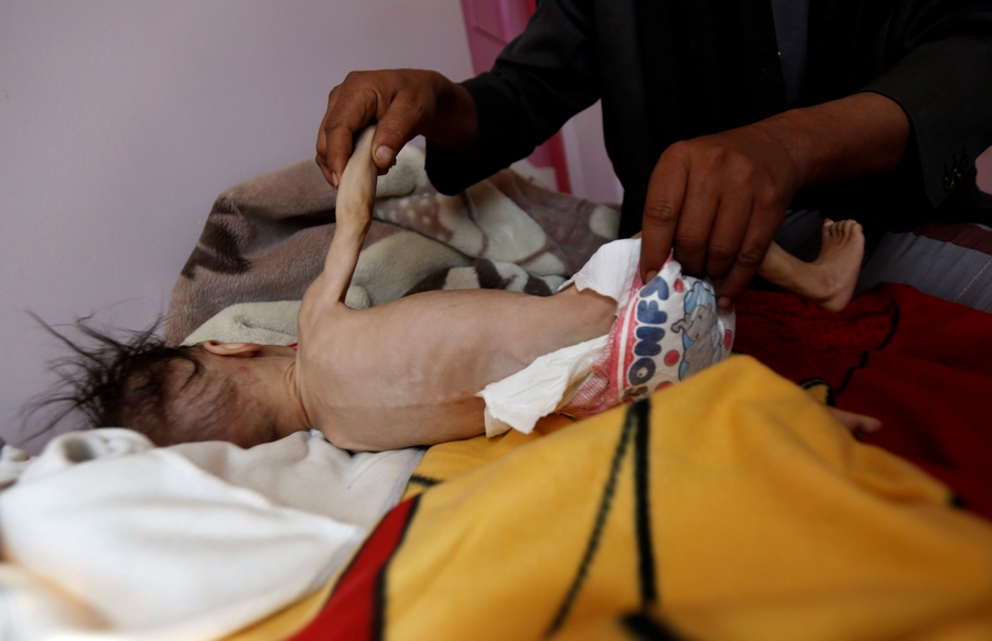 Σοκαριστικές φωτογραφίες: Παιδιά υποσιτισμένα κι ετοιμοθάνατα στην Υεμένη (φωτο)