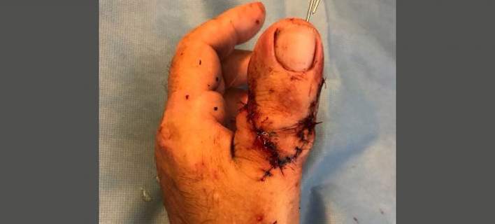 Ολλανδία: Μεταμόσχευσαν δάκτυλο του ποδιού ασθενούς στον κατεστραμμένο αντίχειρά του (φωτό)