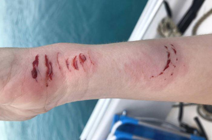 Καρχαρίας επιτέθηκε σε γυναίκα την ώρα που κολυμπούσε (φωτό, βίντεο)