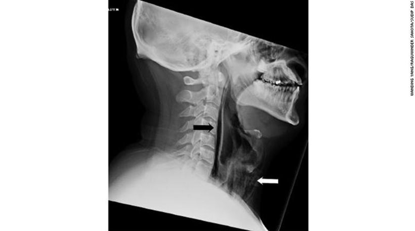 Κράτησε το φτέρνισμά του και τρύπησε ο λαιμός του!