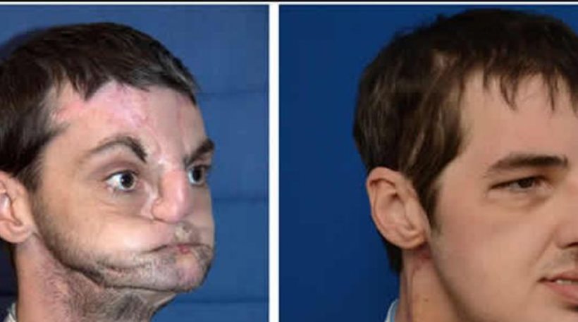 Aπίστευτο: Για 1,5 μήνα έμεινε χωρίς πρόσωπο αφού το σώμα του απέρριψε το μόσχευμα!
