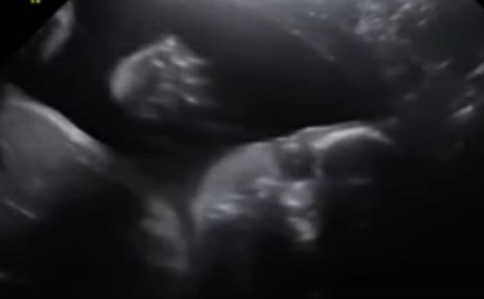 Απίστευτο: Έμβρυο χαιρετά τους γονείς του από το υπερηχογράφημα! (βίντεο)