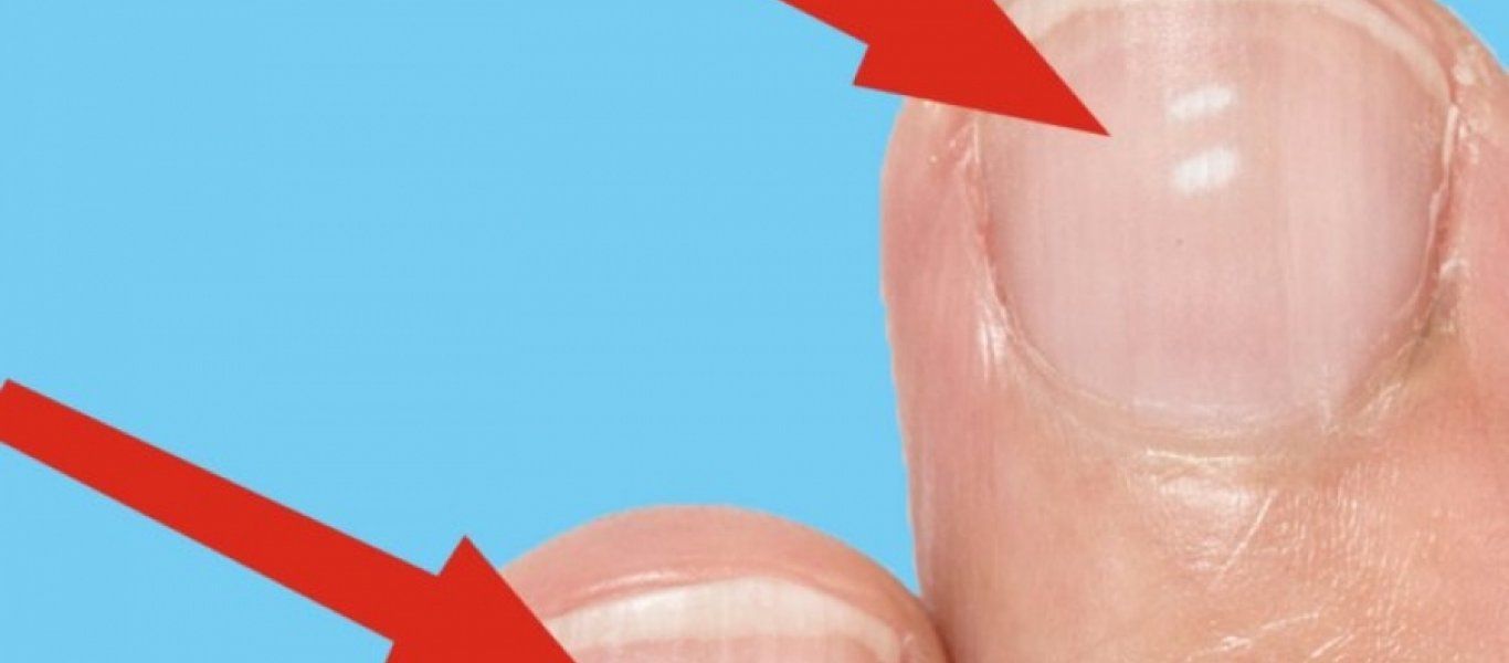 Τι δείχνουν τα λευκά σημάδια στα νύχια για την υγεία μας;