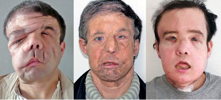 Ο «άνθρωπος με τα τρία πρόσωπα»: Ο πρώτος άνθρωπος που έκανε 2 μεταμοσχεύσεις προσώπου (φωτο)