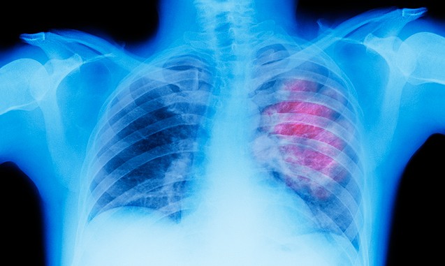 H φυτική ουσία που μπορεί να καταστρέψει το 90% των κυττάρων του καρκίνου του πνεύμονα