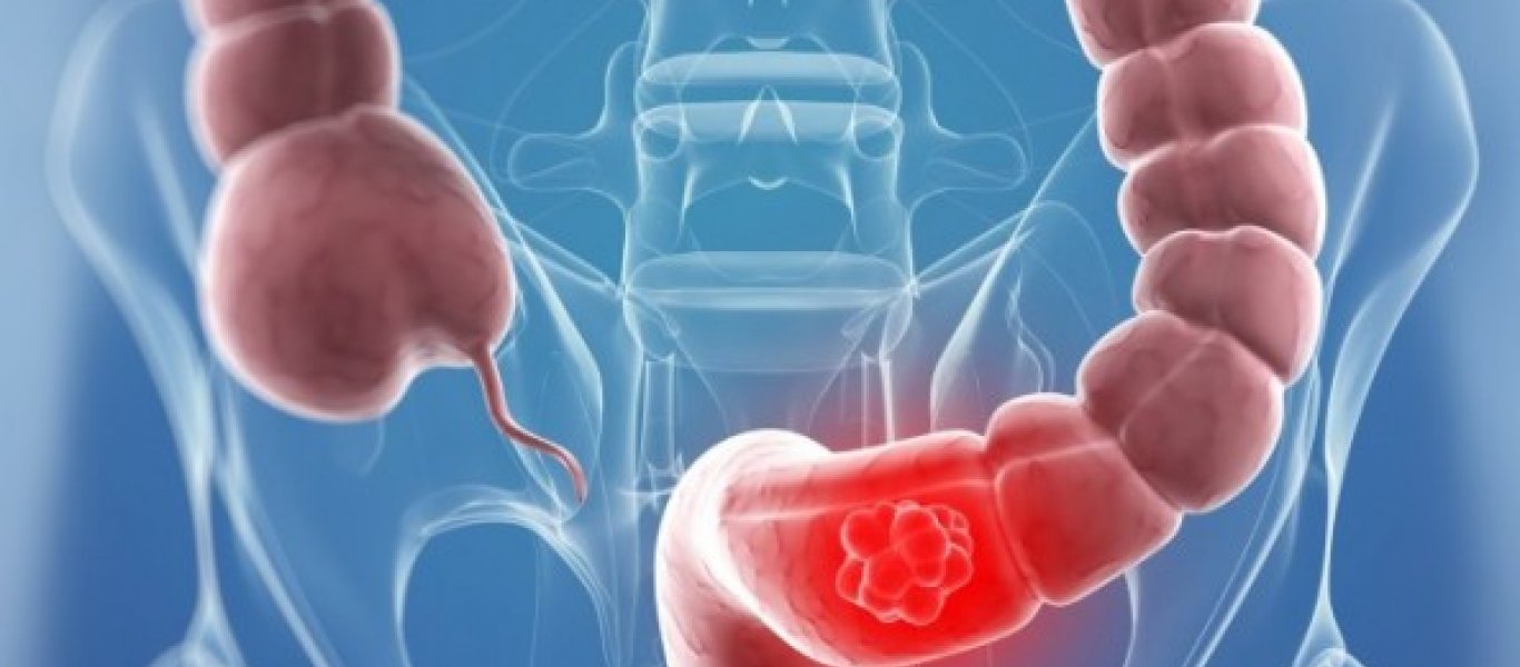 Ποσοστό ύψους 70% των καρκίνων θεραπεύεται ή μετατρέπεται σε χρόνια νόσο