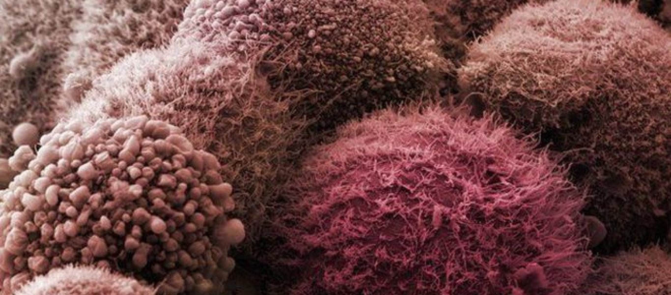 Καρκίνος στο πάγκρεας: Έγκαιρη διάγνωση με τεστ ούρων!