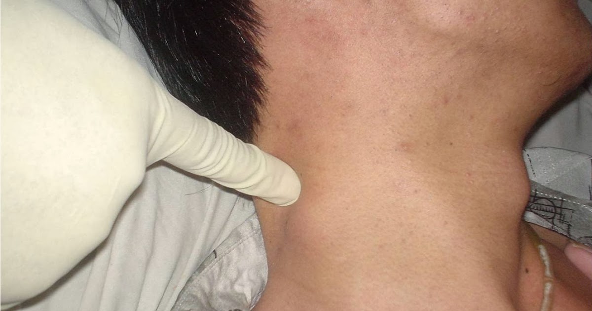 Οργιάζει το λέμφωμα Hodgkin στην Ελλάδα- Η χώρα μας εμφανίζει τα περισσότερα κρούσματα του σπάνιου καρκίνου παγκοσμίως