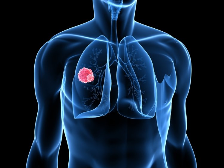 Καρκίνος του πνεύμονα: Συμπτώματα, στάδια και παράγοντες που ευνοούν την εμφάνισή του