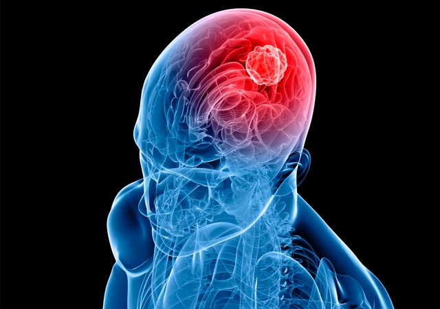 Τα 7 σημάδια που πρέπει να γνωρίζετε για πιθανό όγκο στον εγκέφαλο