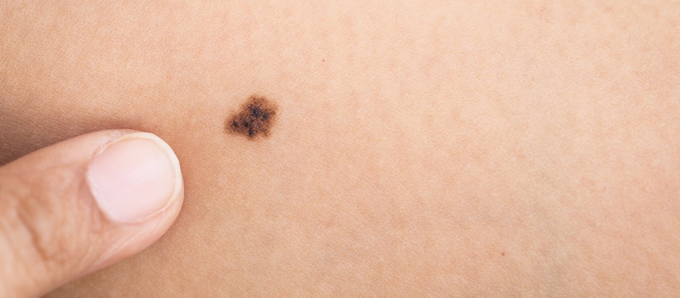 Αυτό είναι το πρώτο τεστ για την διάγνωση μελανώματος