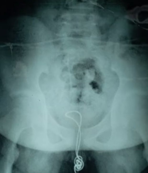 13χρονος έβαλε ένα καλώδιο USB στα γεννητικά του όργανα και κατέληξε στο νοσοκομείο  (φωτό)