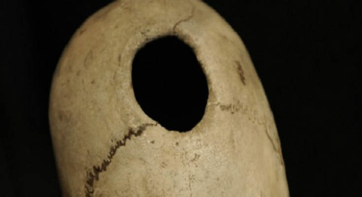 Μυστήρια της ανθρωπότητας: Γιατί οι πρόγονοι μας τρυπούσαν τα κρανία τους;