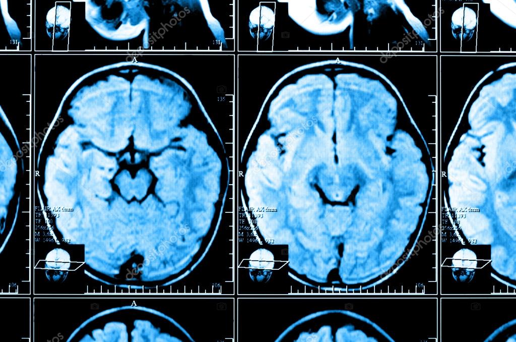 ΗΠΑ: Σύστημα τεχνητής νοημοσύνης εντοπίζει εγκεφαλικές παθήσεις σε 1,2 δευτερόλεπτα