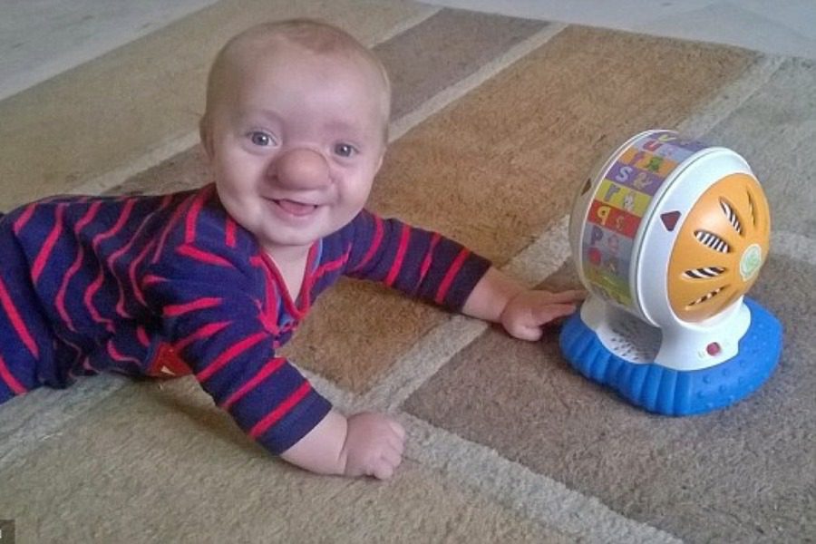 Ένα μωρό πινόκιο: Η μύτη έκρυβε τον εγκέφαλό του (φωτό)