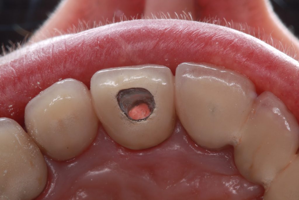 Τρύπες στα δόντια: Πώς και γιατί δημιουργούνται (βίντεο)