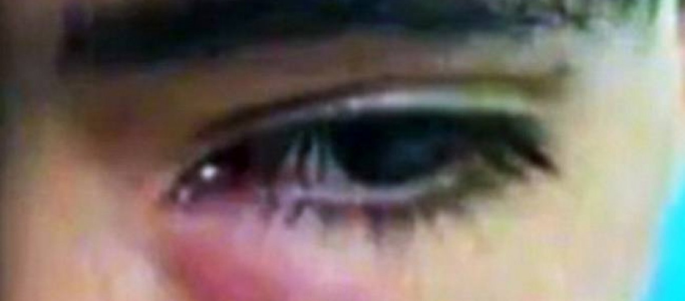Φρίκη: Δείτε τι… έκρυβε στο μάτι του για ένα μήνα (Βίντεο)