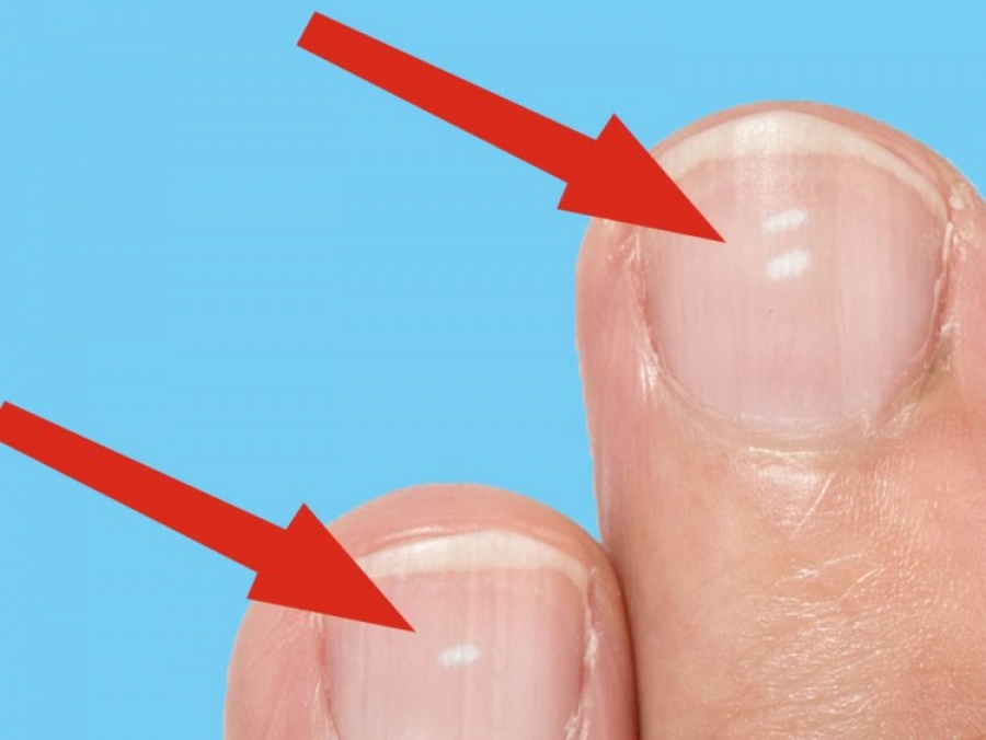 Τι δείχνουν τα λευκά σημάδια στα νύχια για την υγεία μας;