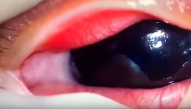 Γιατροί έβγαλαν σκουλήκια από το μάτι βρέφους – Μολύνθηκε από κατοικίδιο (φώτο-βίντεο)