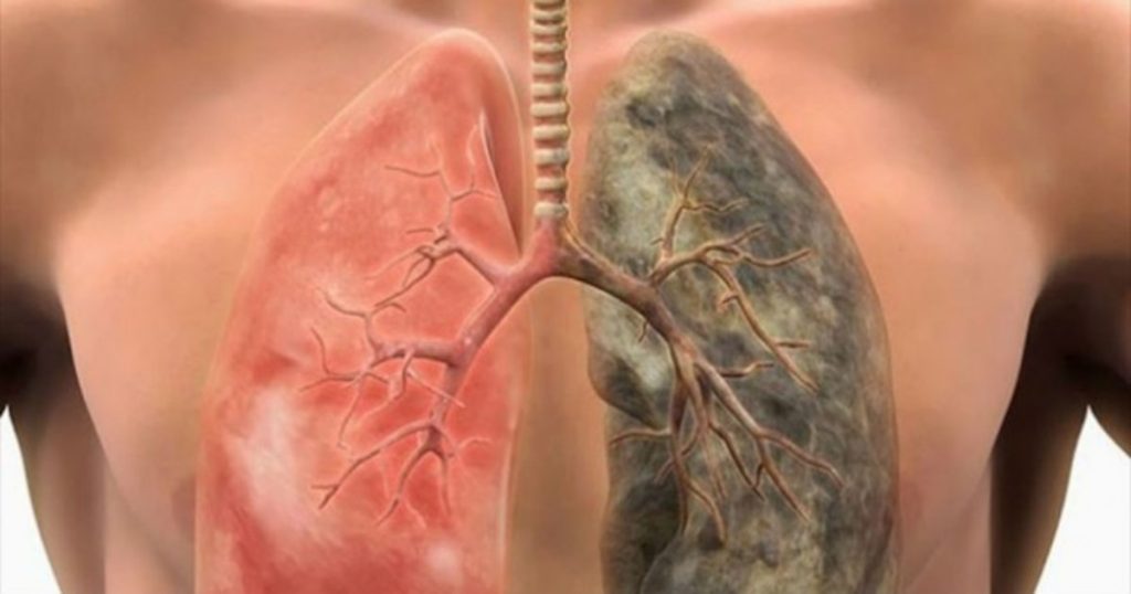 Κάπνισμα: Φτιάξτε «ελιξίριο» καθαρισμού των πνευμόνων σας (φωτό)