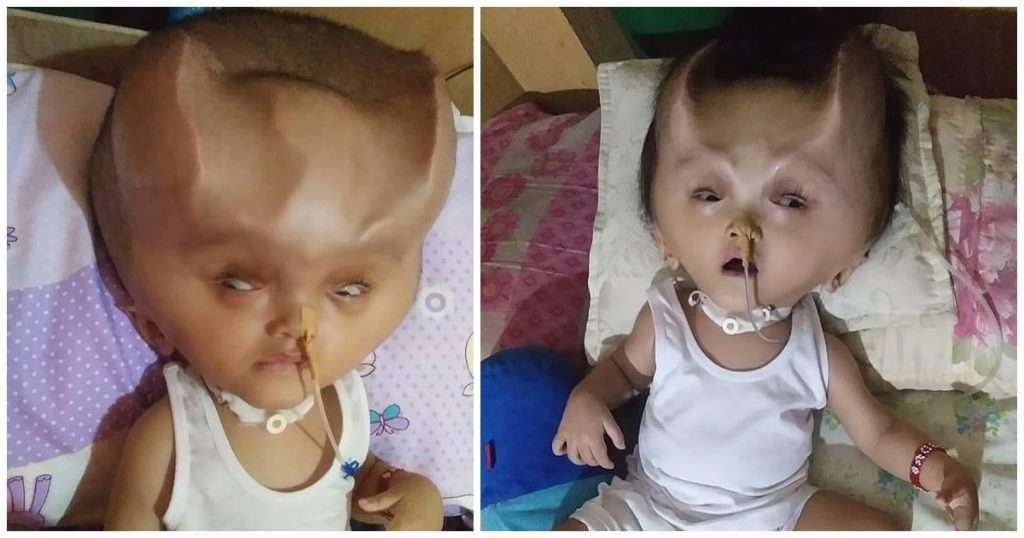 Μωρό έβγαλε «διαβολικά κέρατα» στο κεφάλι λόγω σπάνιας ασθένειας που του παραμόρφωσε το κρανίο! (φώτο-βίντεο)