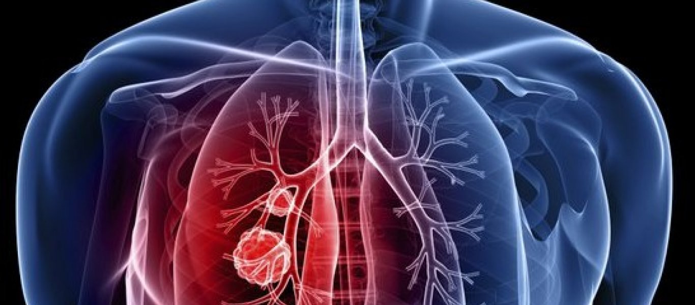 Καρκίνος του Πνεύμονα – Συμπτώματα και Αίτια
