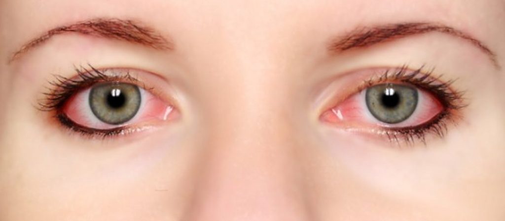 Κοκκινίζουν συχνά τα μάτια σου; – Αιτίες και τρόποι πρόληψης