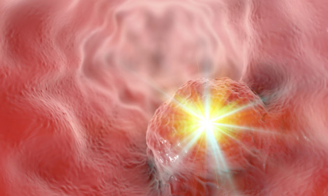 Πολλοί αγνοούν σαν «κάτι περαστικό» αυτά τα πρώιμα συμπτώματα καρκίνου του στομάχου